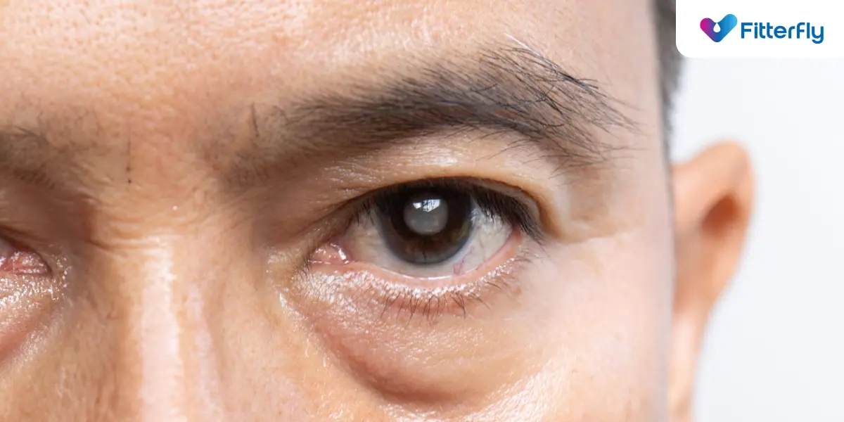 Diabetes and Cataracts: Causes, Symptoms, & Treatments cataracts and diabetes