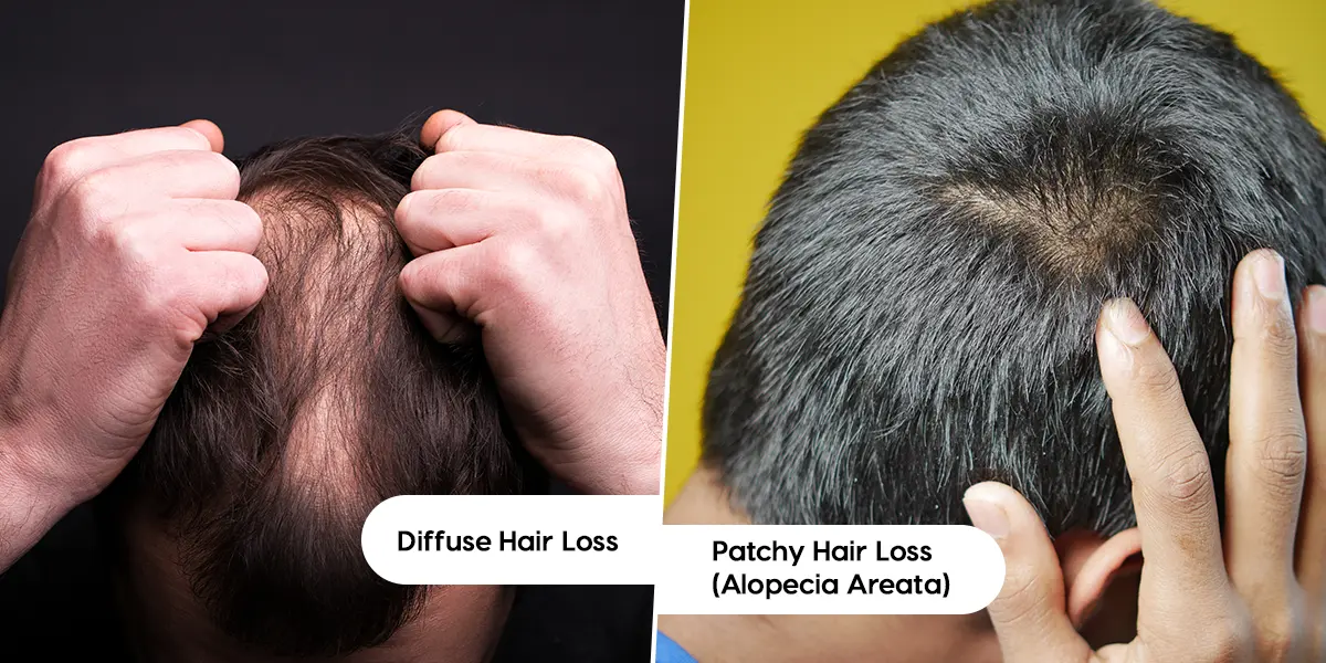 Types of diabetes related hair loss.